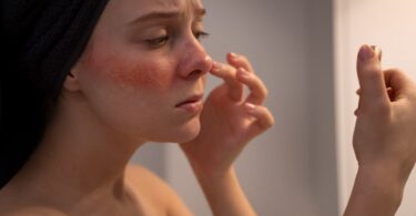 Rosacea Self Care: How to Manage Redness and Flare-Ups