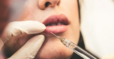 Lip Filler Singapore