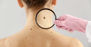 Dermatologist Singapore skin cancer screening for early detection and prevention.