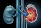 Kidney Stones Treatment Singapore