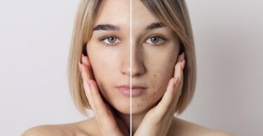 Does Vitamin C Treat Melasma? Benefits & Effectiveness Explained
