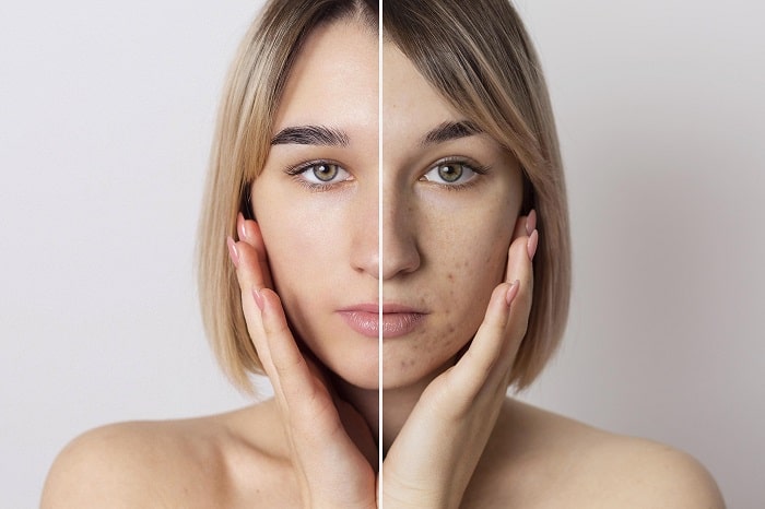 Does Vitamin C Treat Melasma? Benefits & Effectiveness Explained