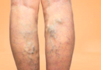 Best Home Remedy for Varicose Veins: Natural Relief & Treatments