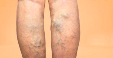 Best Home Remedy for Varicose Veins: Natural Relief & Treatments