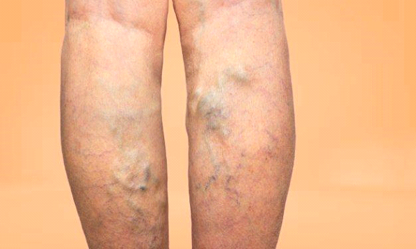 Best Home Remedy for Varicose Veins: Natural Relief & Treatments