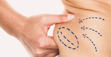 Achieve Your Dream Body with Liposuction