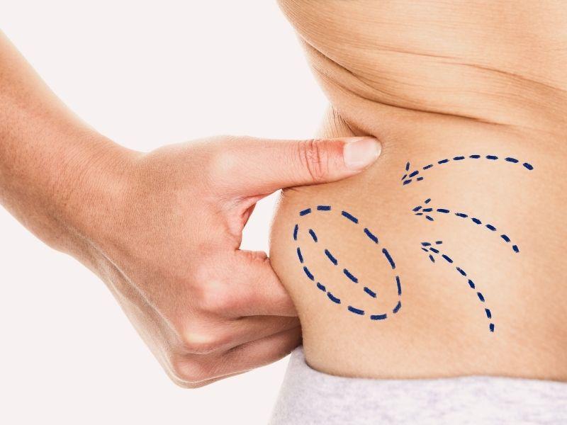 Achieve Your Dream Body with Liposuction
