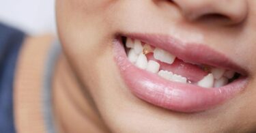 Best Dentist for Missing Teeth – How to Choose the Right Specialist