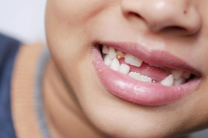 Best Dentist for Missing Teeth – How to Choose the Right Specialist