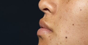 Melasma: Finding the best treatment for different skin types