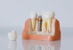 Why Are Dental Implants a Must-Have for Dentists?