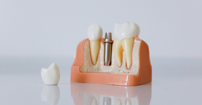 Why Are Dental Implants a Must-Have for Dentists?