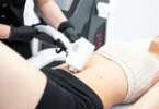 Laser Lipo vs. Traditional Fat Reduction